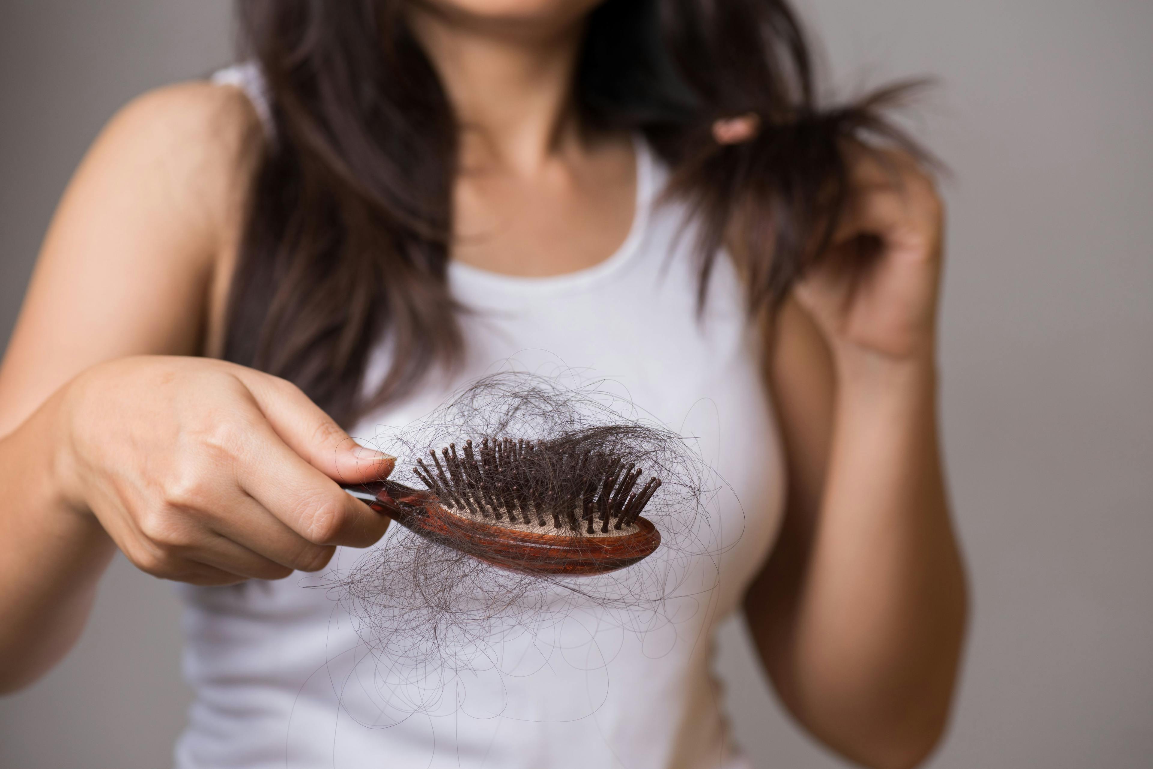Woman experiences hair loss | Image Credit: Siam - stock.adobe.com