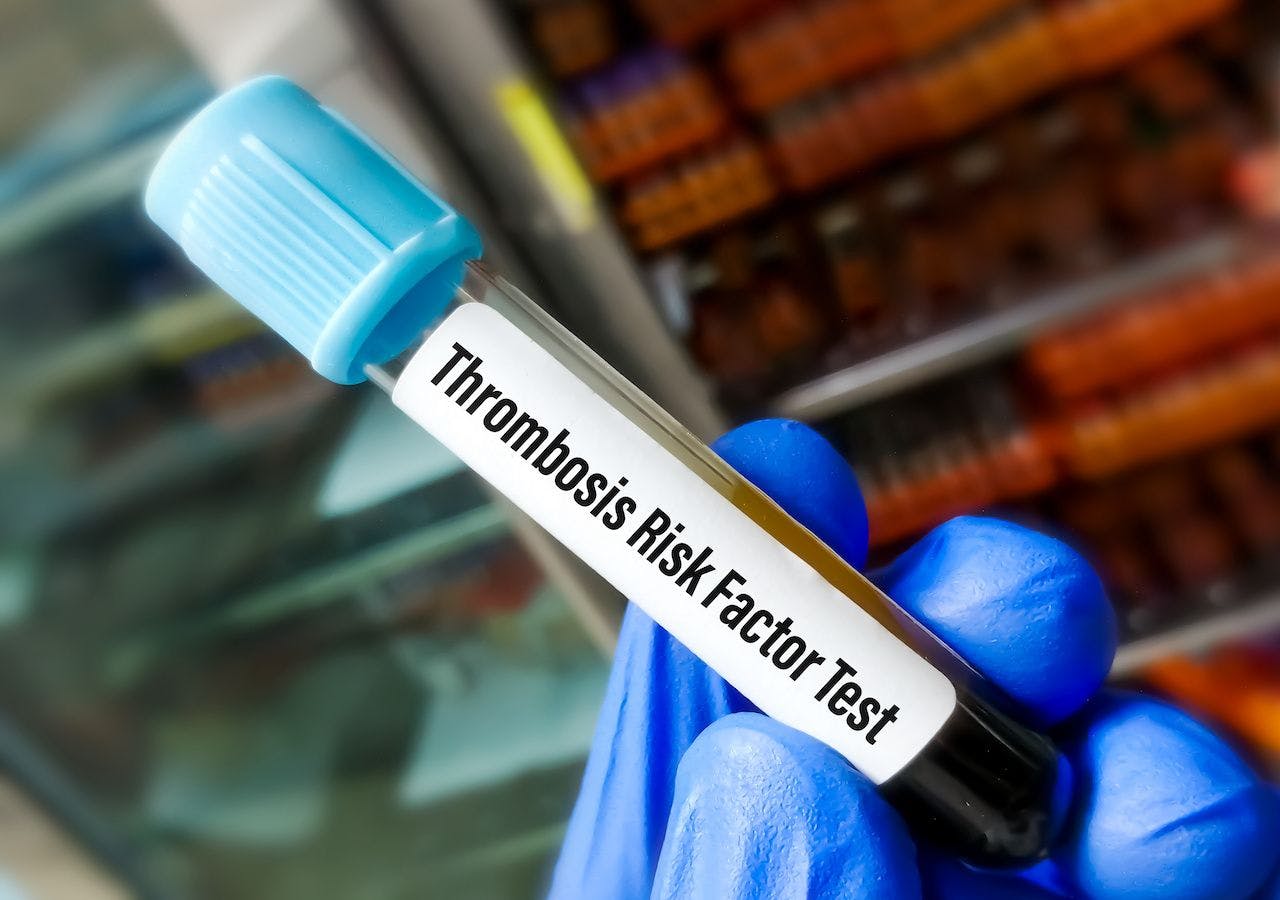 Doctor holding Blood tube for Thrombosis Risk factor test. Bleeding disorder: © Saiful52 - stock.adobe.com