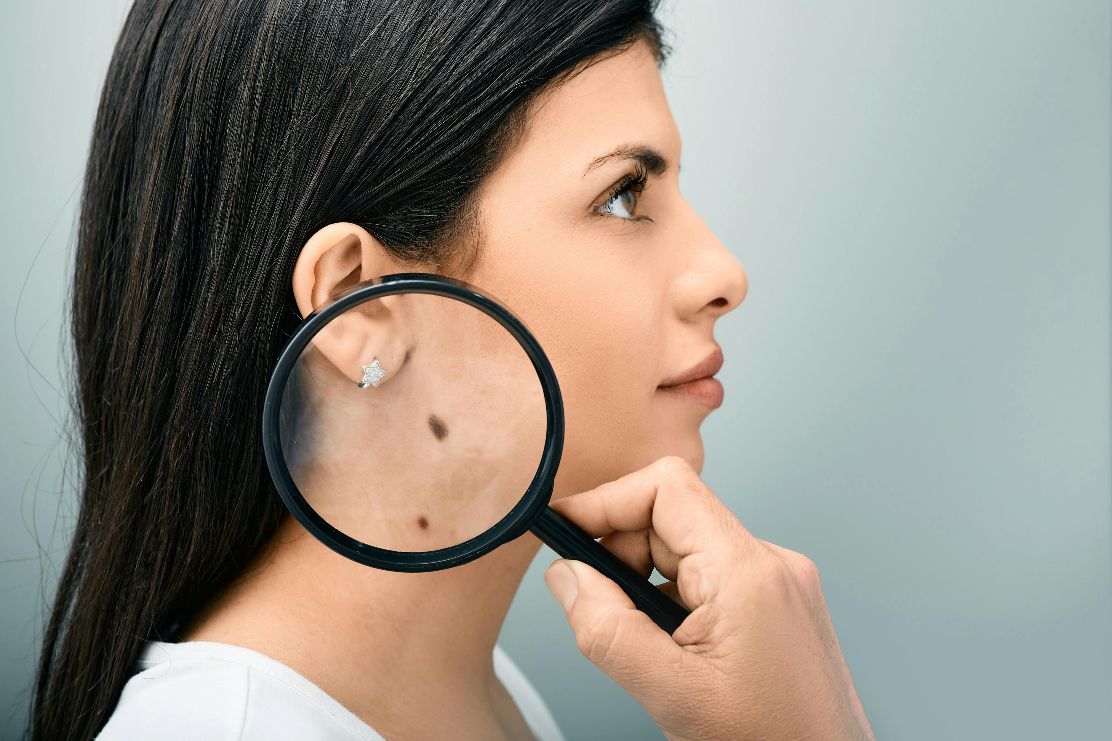 Woman with magnifying glass showing mole and birthmark on her body for prevention of melanoma | Peakstock - stock.adobe.com