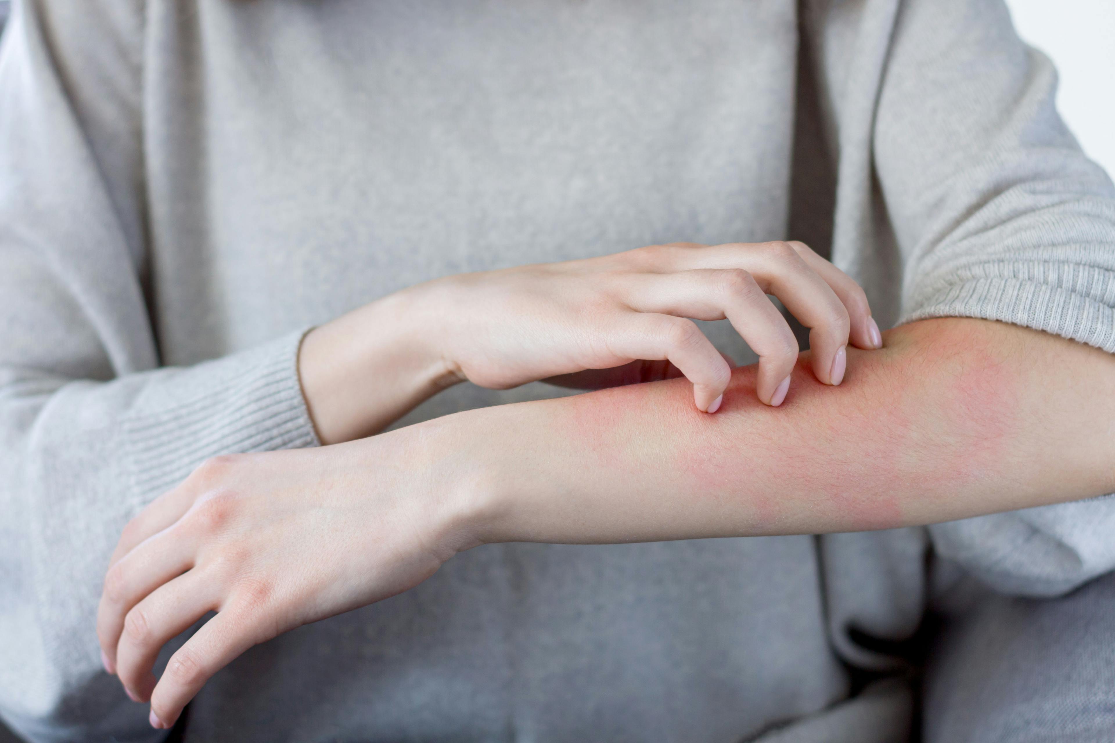 woman scratching her atopic dermatitis
