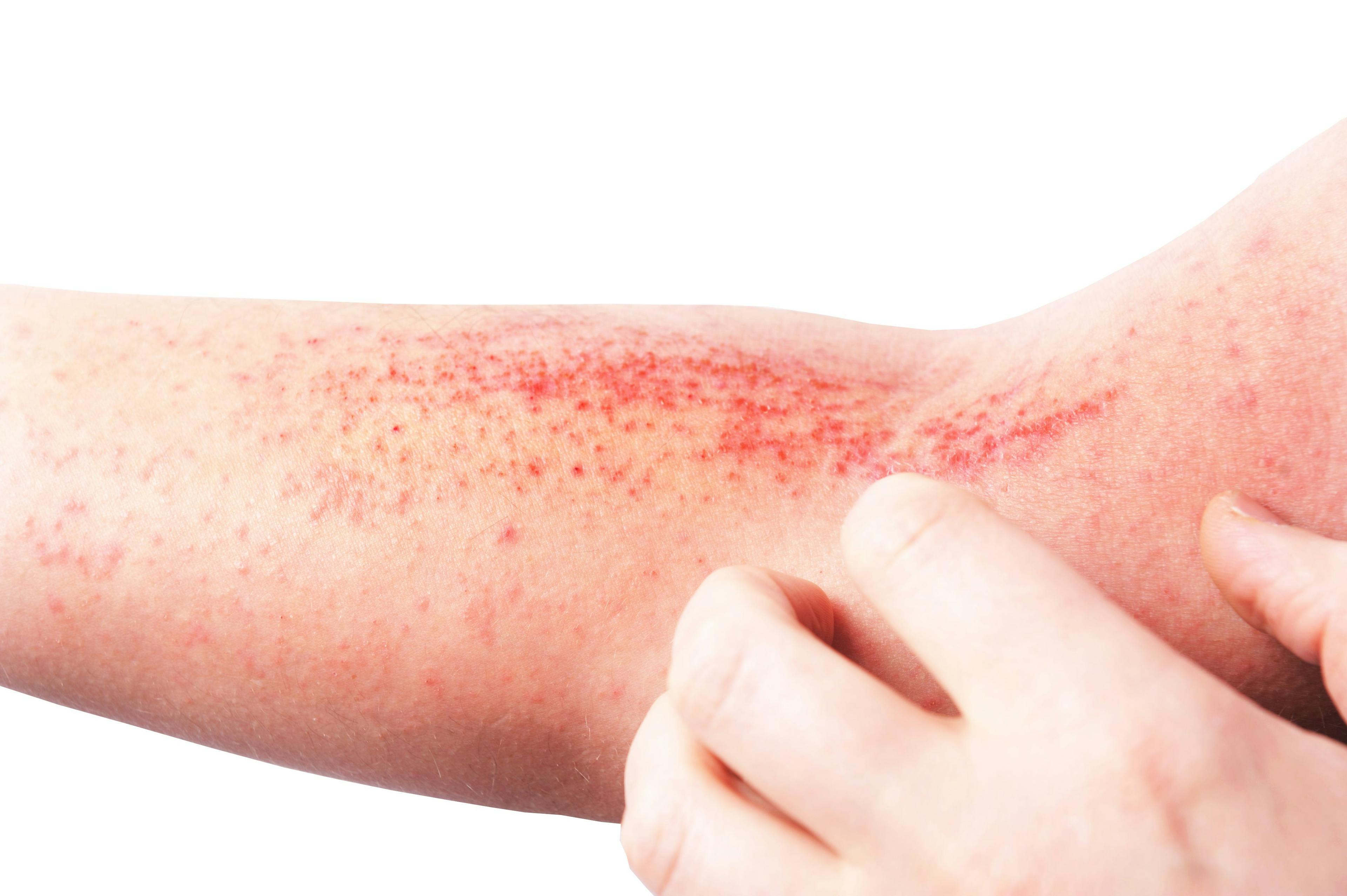 Patient scratching atopic dermatitis on their arm. | Image Credit: lial88 - stock.adobe.com