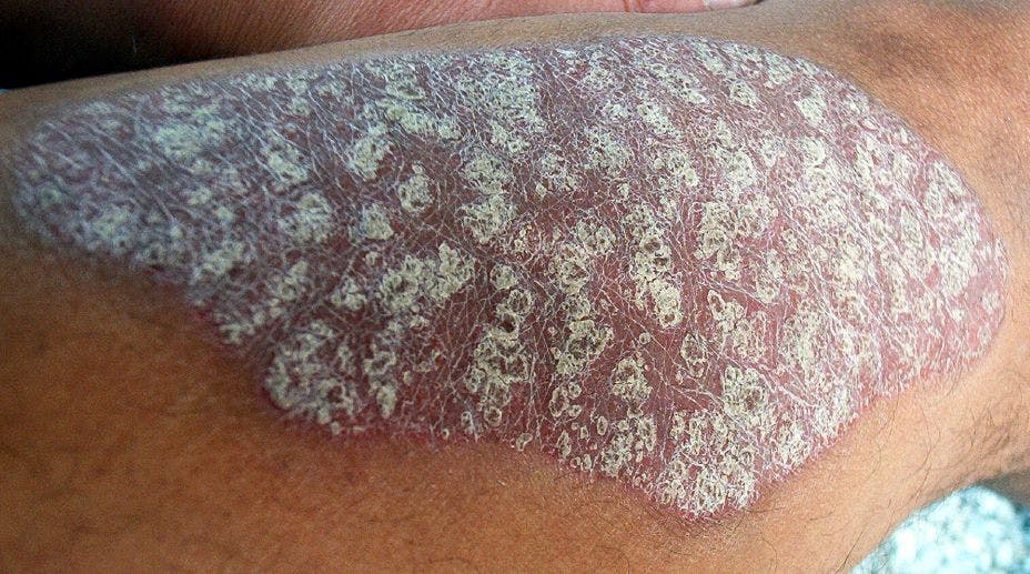 Tildrakizumab Shows Long-term Safety, Efficacy in Patients With Plaque Psoriasis in Japan