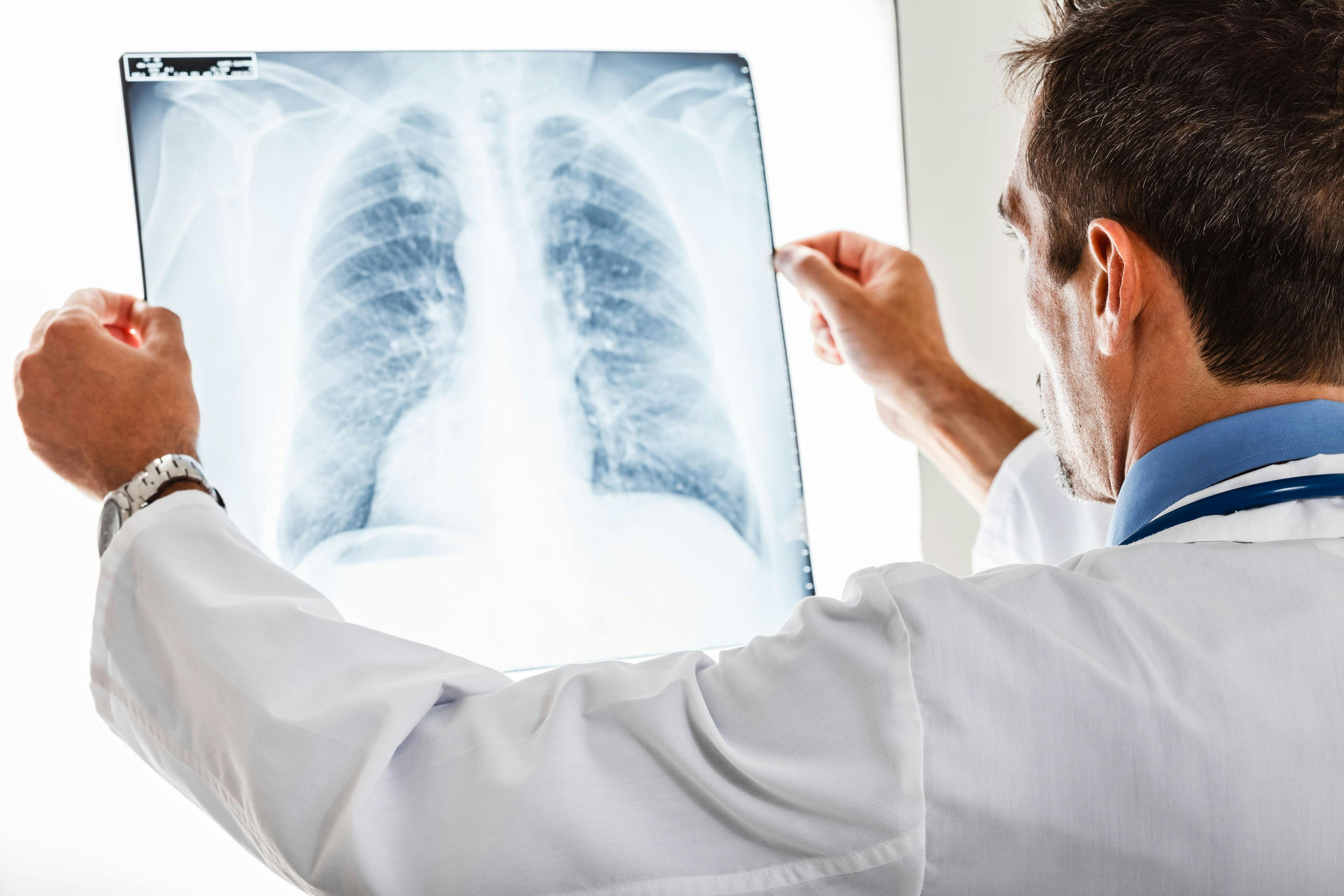 Doctor looking at lung radiography