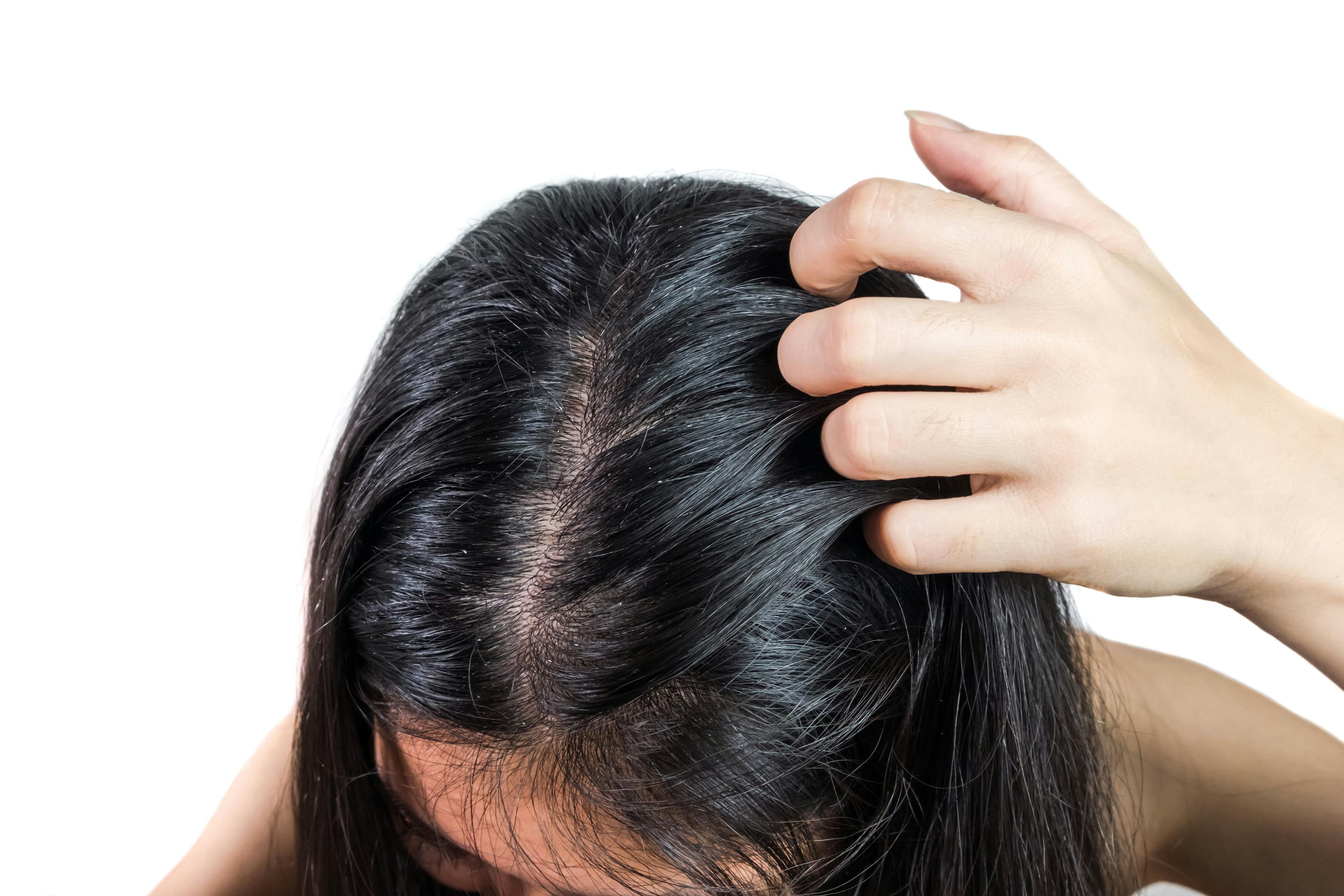 Woman with scalp itch | Small fish - stock.adobe.com