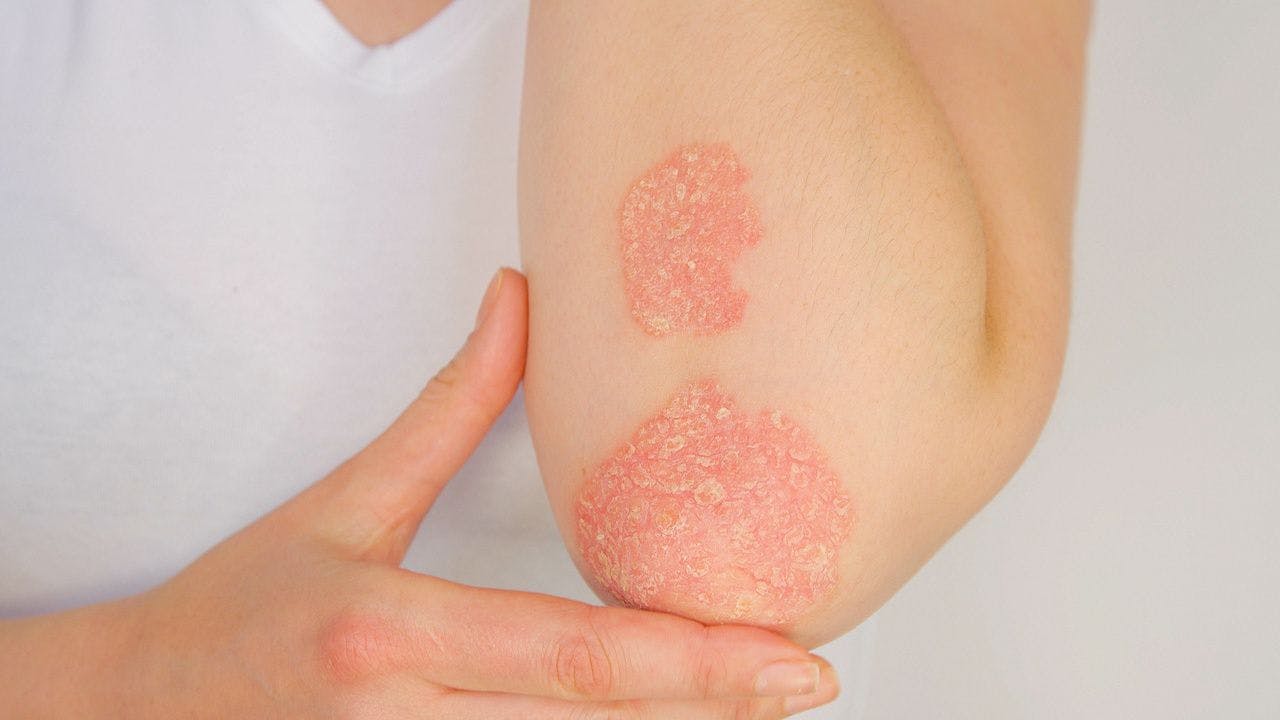 CLOSE UP Woman with big red scaly rash suffering from elbow psoriatic arthritis: © helivideo - stock.adobe.com