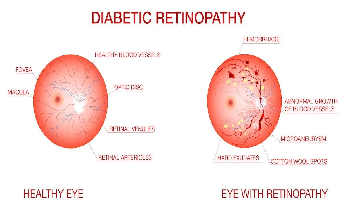 Anatomy of normal eye and diabetic retinopathy diagram of the eye | Image credit: Koroleva - stock.adobe.com