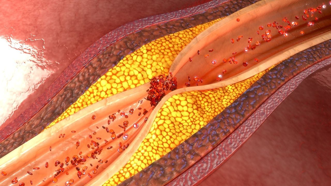 Higher Risk of Atherosclerosis Not Apparent in HIV-Positive Individuals