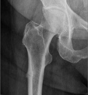 Timing of Low Molecular Weight Heparin Does Not Affect Mortality in Hip Fracture Surgery 