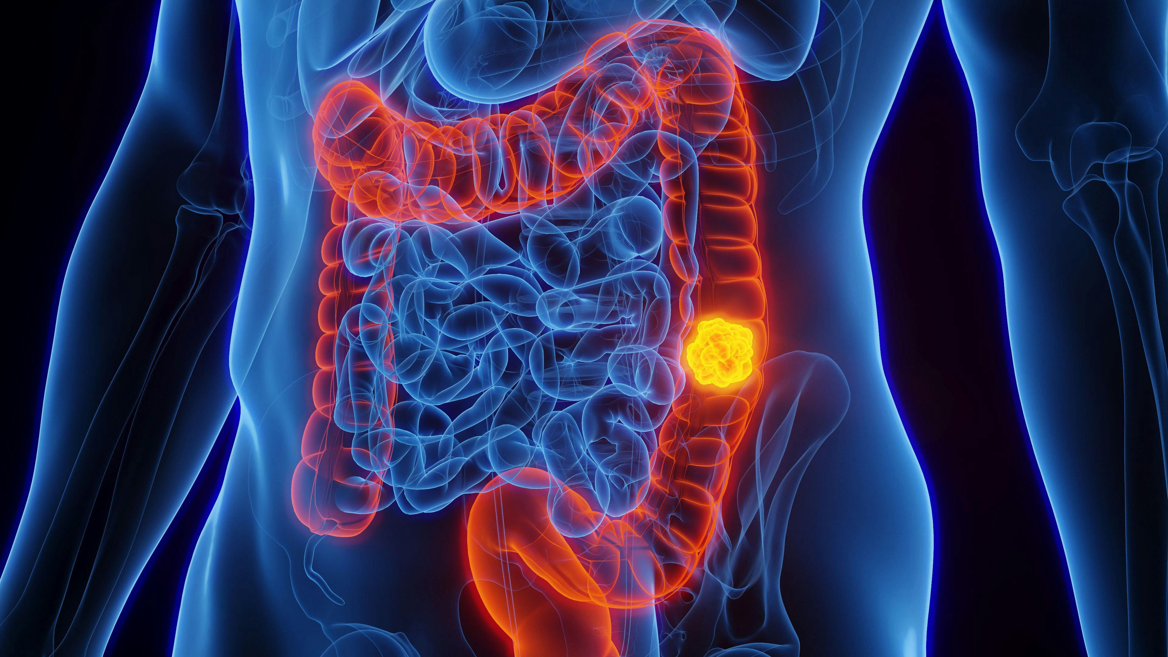 Higher Rate of Metastasis to Main Nodes in Transverse Colon Cancer