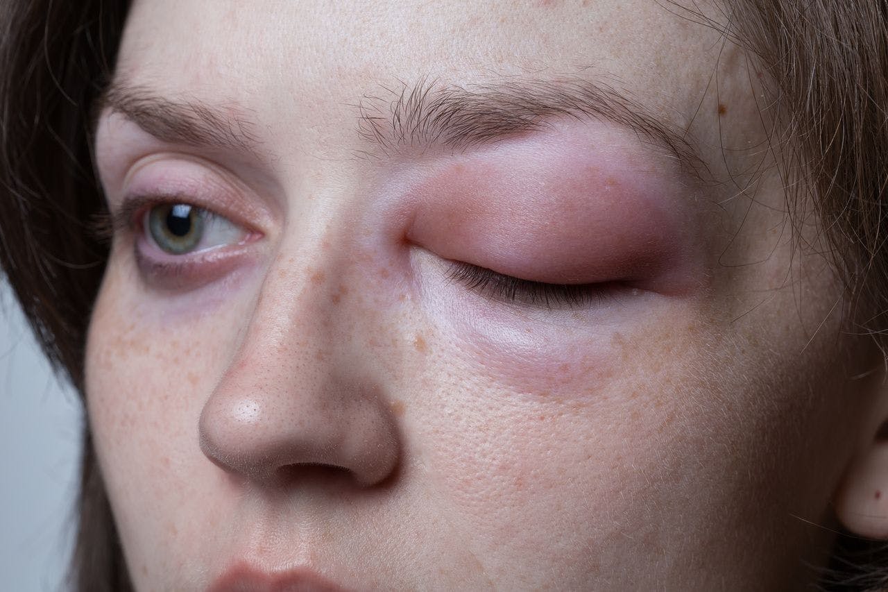 Image of swollen eyelid