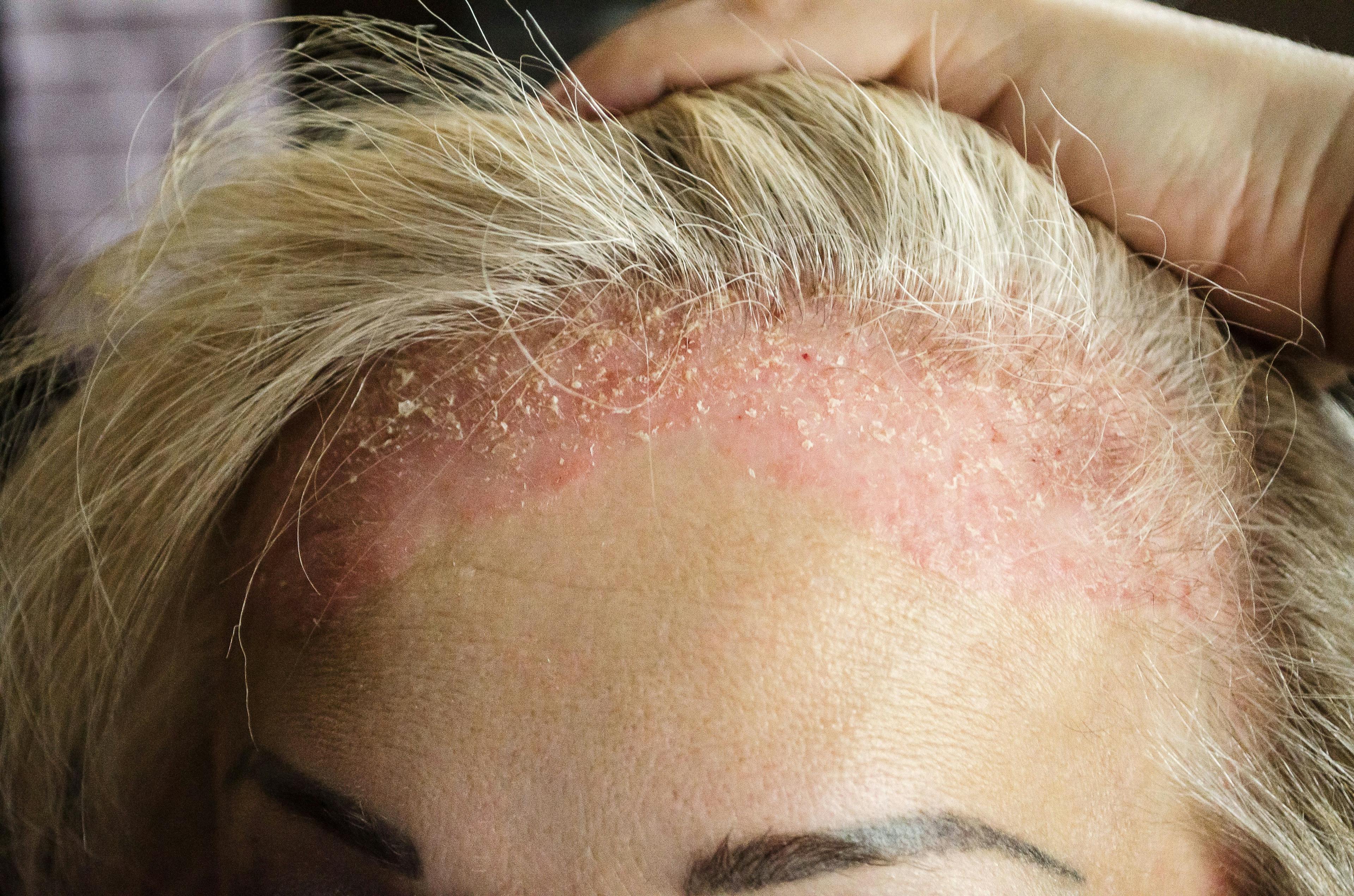 Dermatological skin disease. psoriasis, eczema, dermatitis, allergies. Skin lesions on the head. | Егор Кулинич - stock.adobe.com