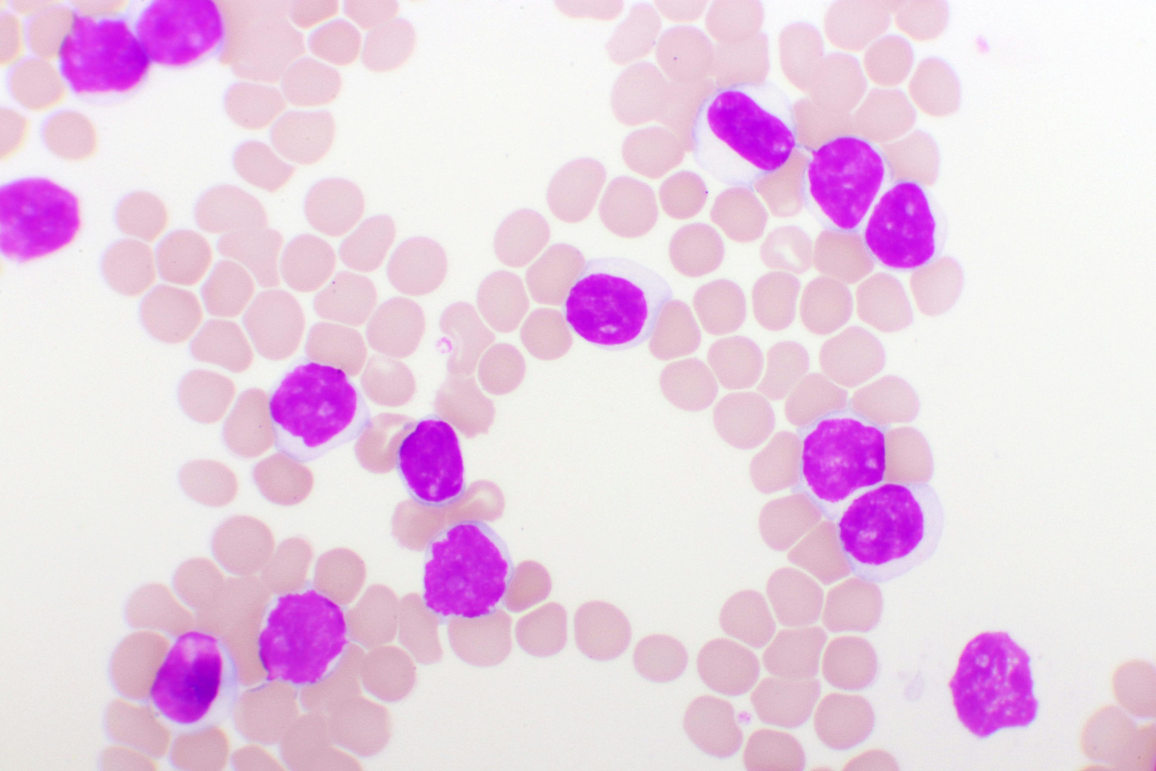 Marrow Lymphocyte Patterns After ASCT May Have Prognostic Value in MM