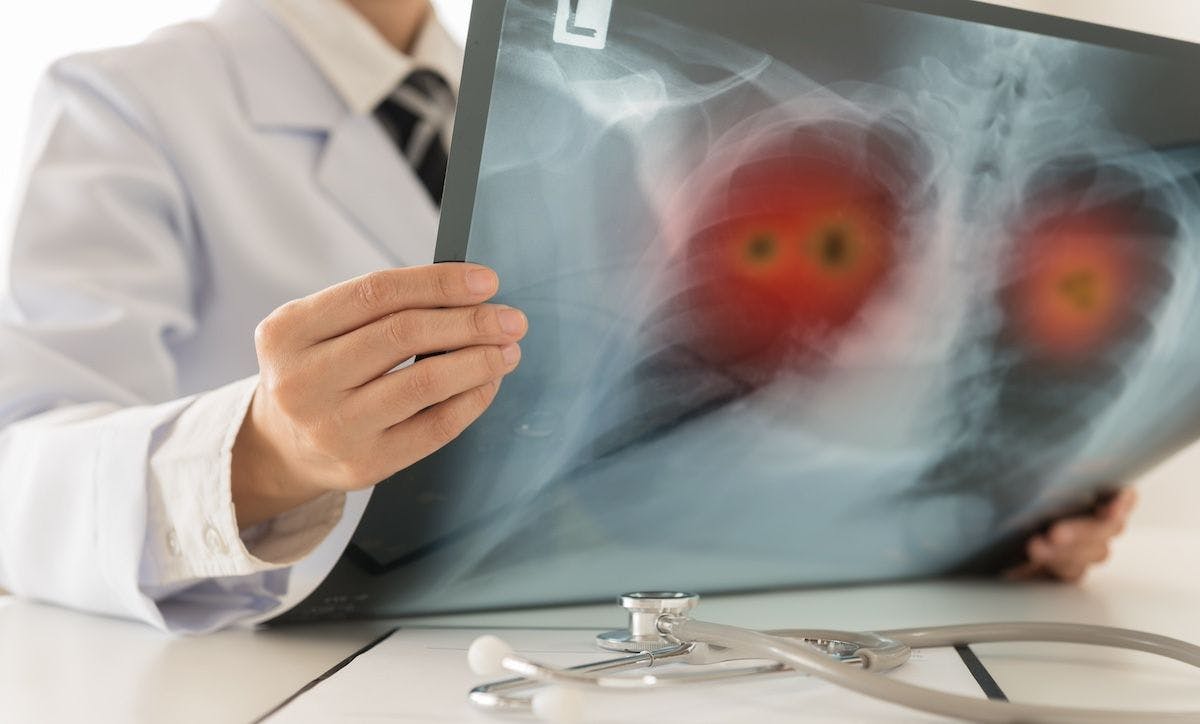 radiology x-ray lung cancer | Image Credit: utah51 - stock.adobe.com