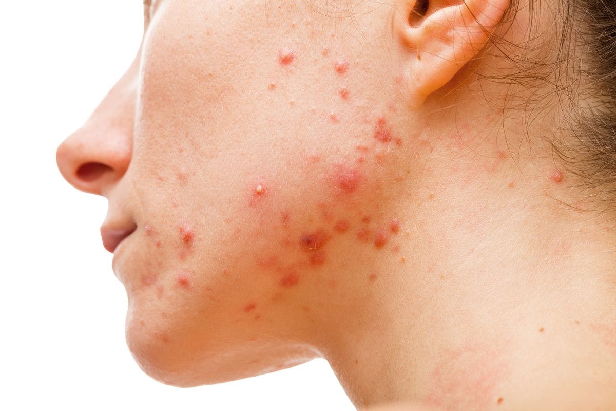 acne on a person's jawline