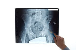 Despite Mortality Risk, Women Over 80 With Osteoporosis Have High 5-Year Risk of Hip Fracture