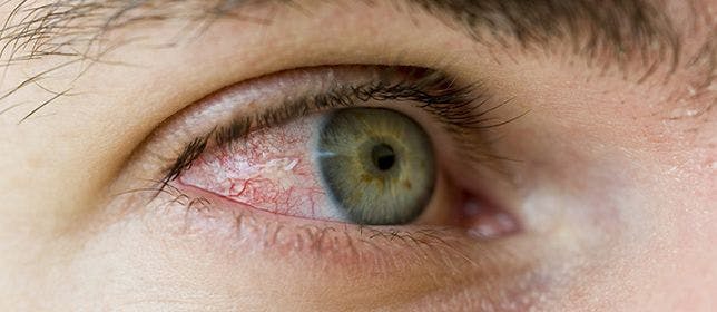 Understanding the Relationship Between Dry Eye and Migraine