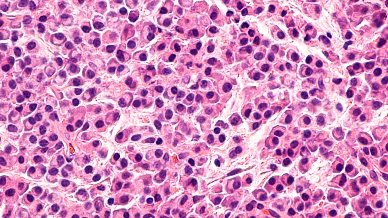 Picture of abnormal cells in bone marrow