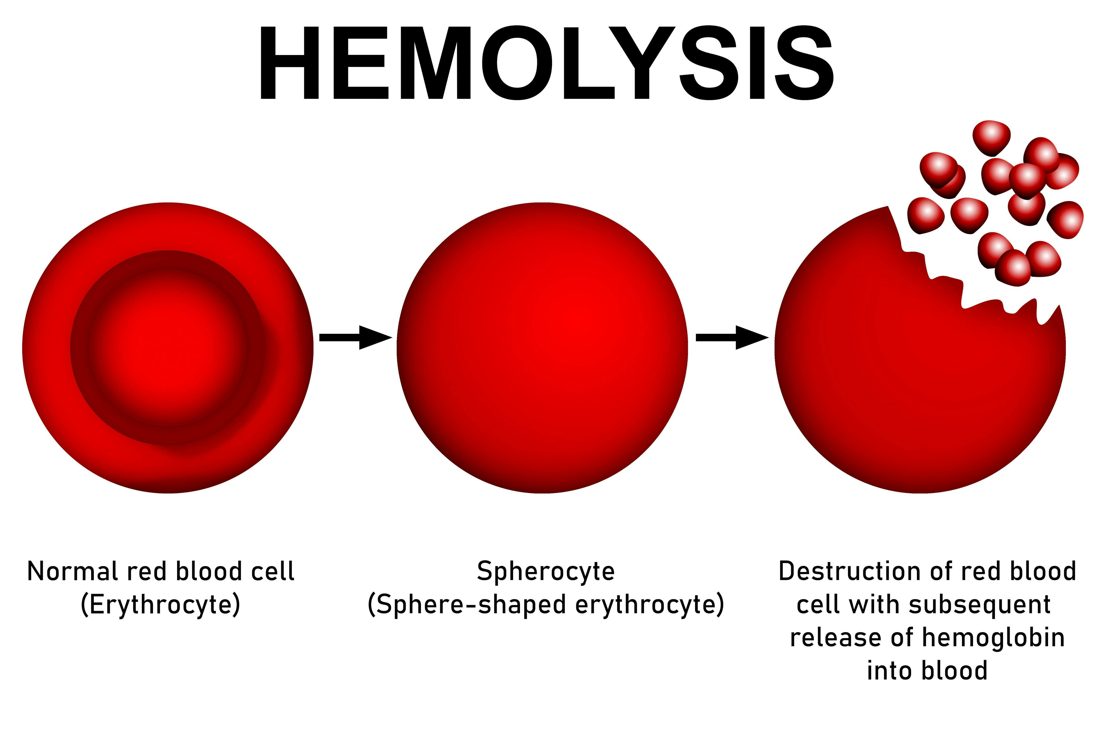 Hemolysis Model | image credit: tang90246 - stock.adobe.com