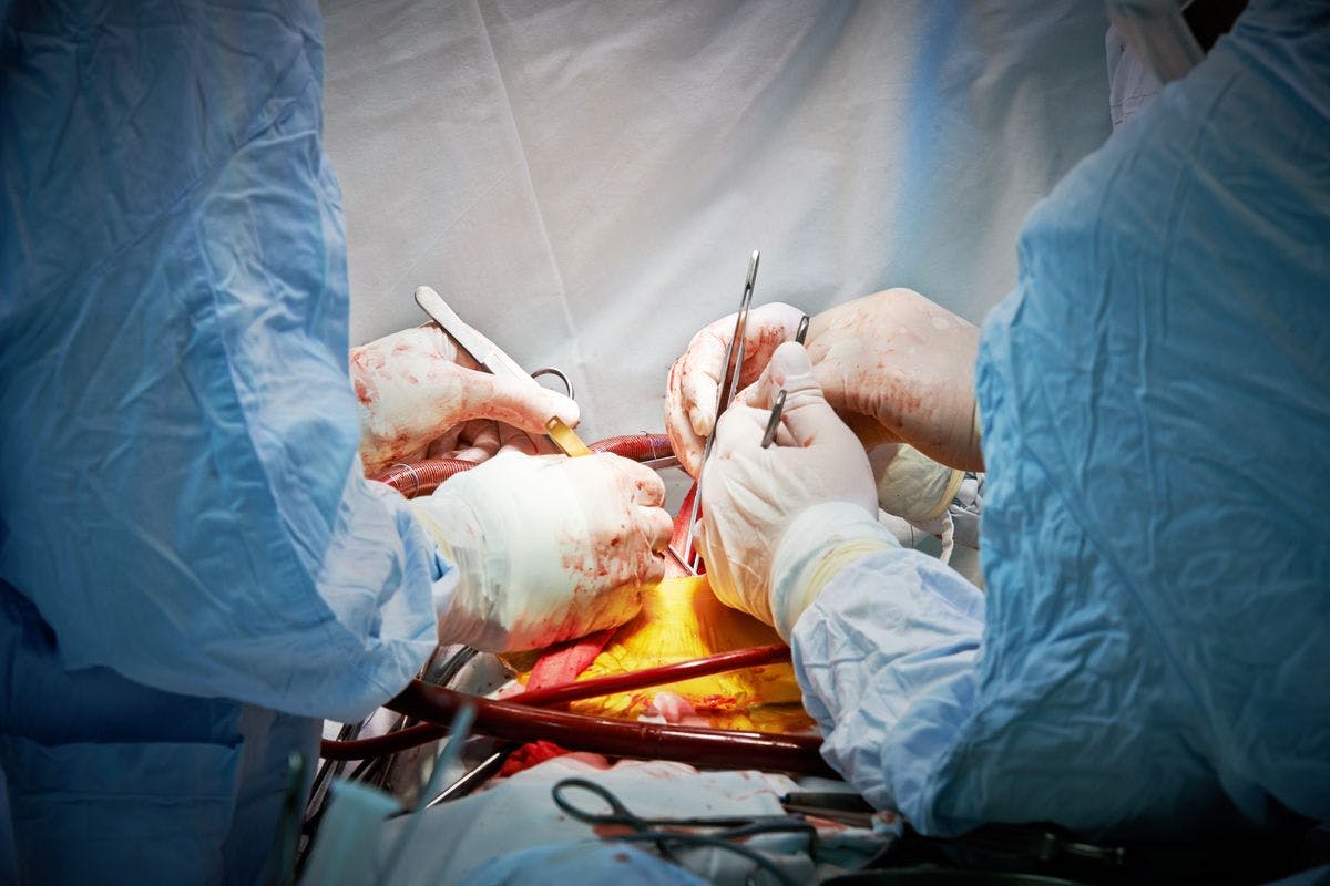 Image of a transplant surgery