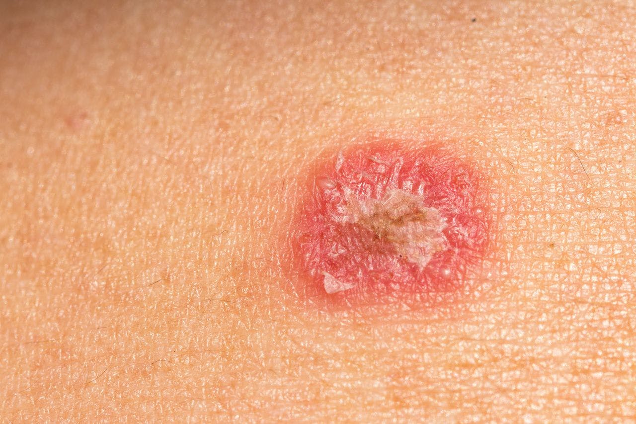 Pair of Studies Explore Role of Key Proteins in Psoriasis