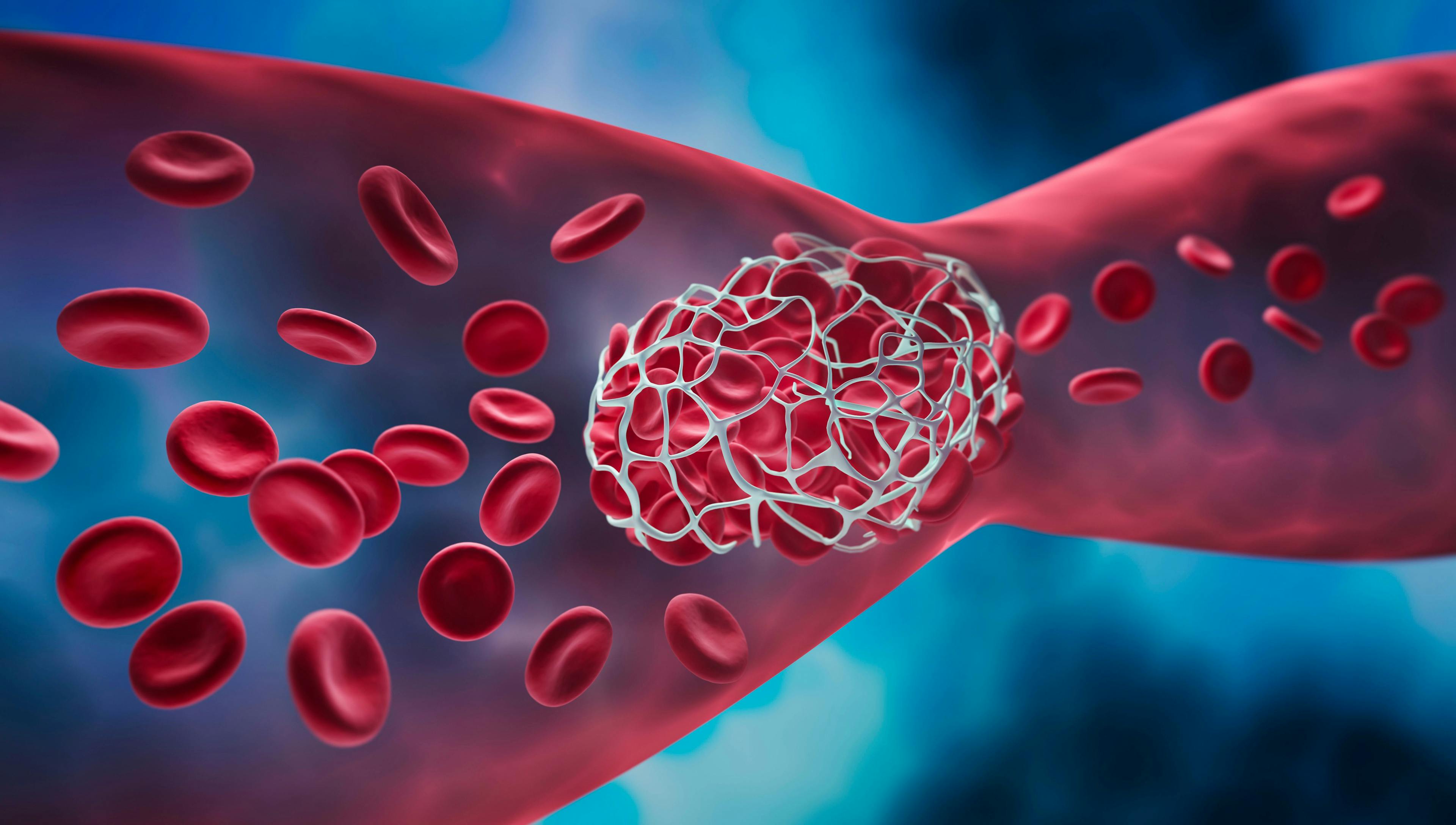Study Identifies Risk Factors for Thromboembolic Events in Patients With PNH