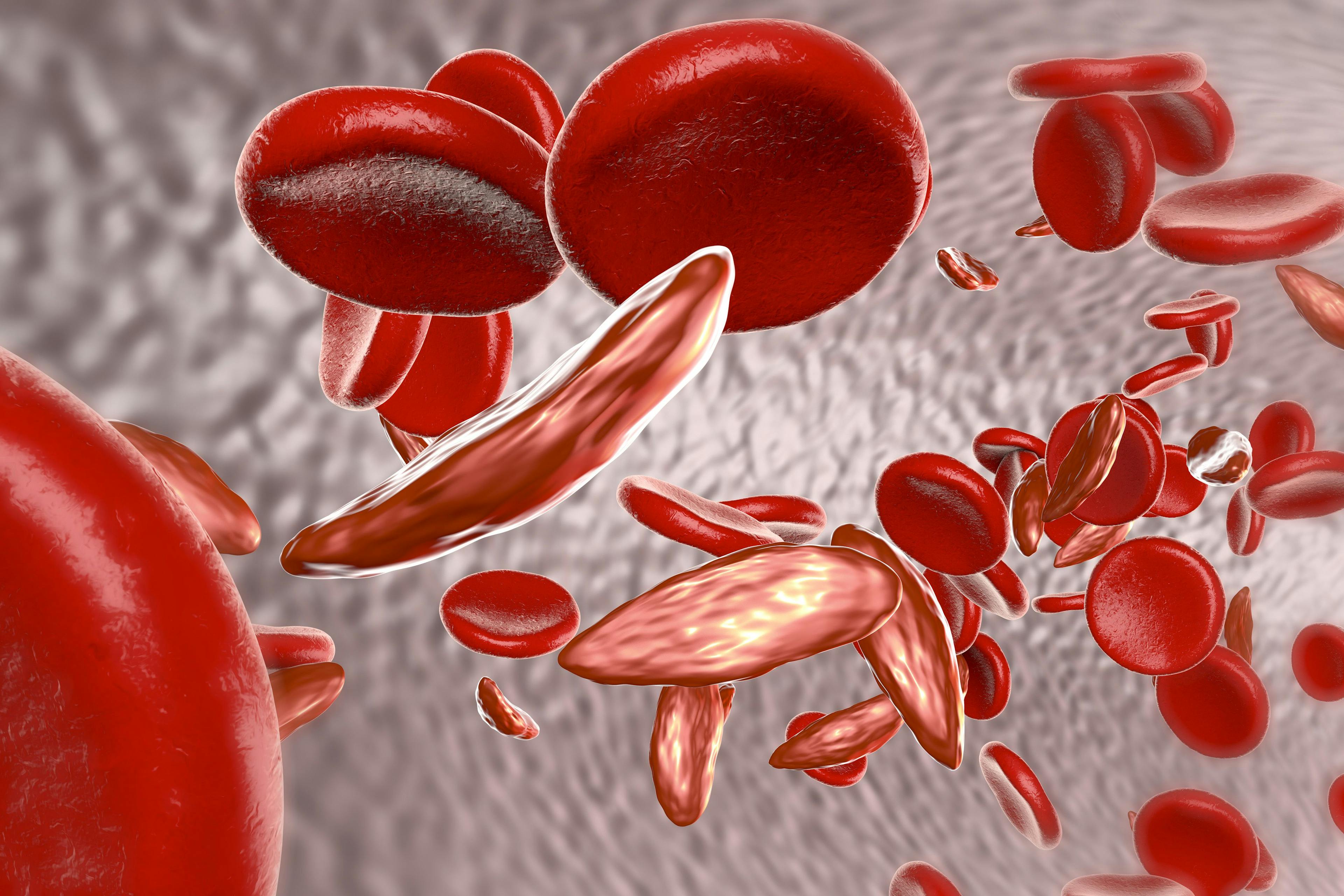 The Impact of Sickle Cell Disease Severity on HRQOL and Economic Outcomes