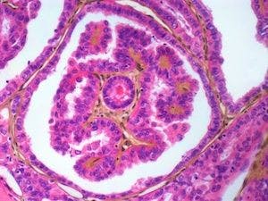 Genetic Analysis of Thyroid Cancer Suggests Personalized Treatment Possible