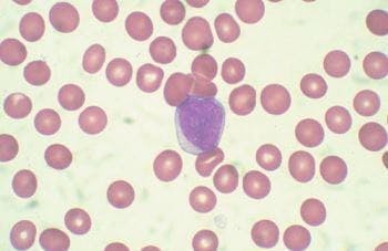 acute lymphoblastic leukemia blasts