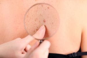 Study Finds Merkel Cell Carcinoma Incidence Has Increased Since 2000