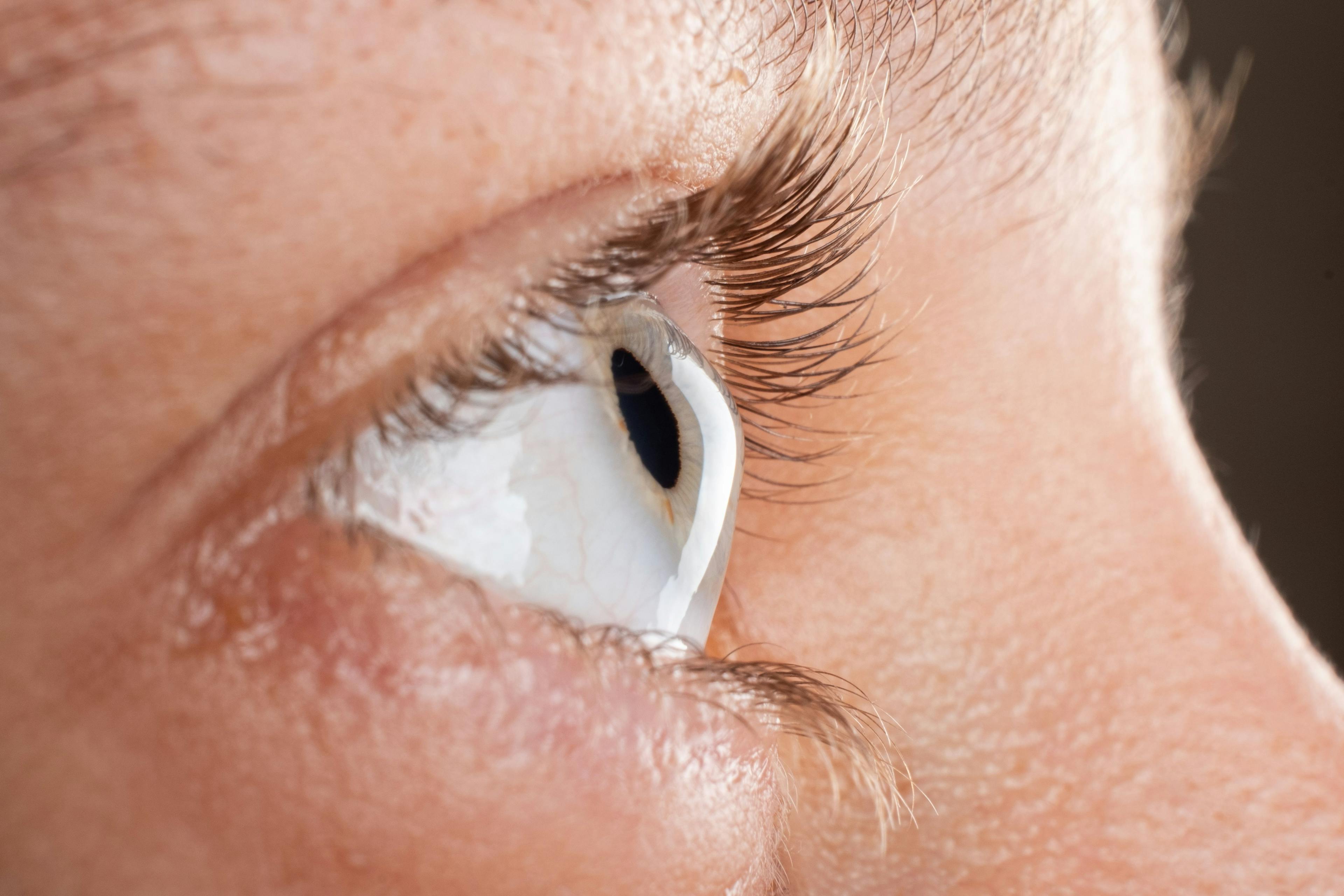 Female eye diagnosed with keratoconus corneal thinning | Image credit: Fukume - stock.adobe.com