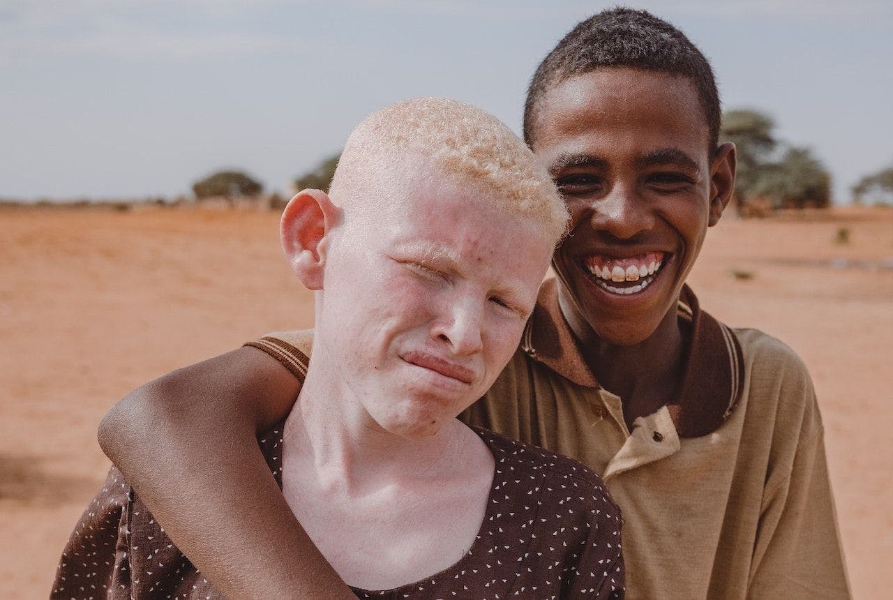 albino skin