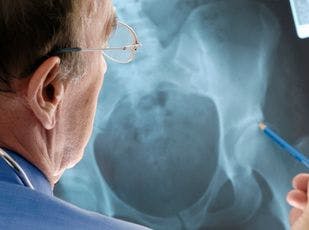 Majority of People Who Have Stroke Not Screened for Osteoporosis Despite Increased Risk