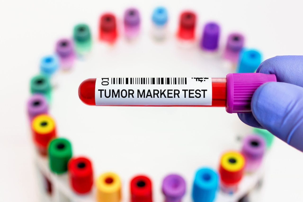 Tumor marker for analysis | Image credit: angellodeco - stock.adobe.com