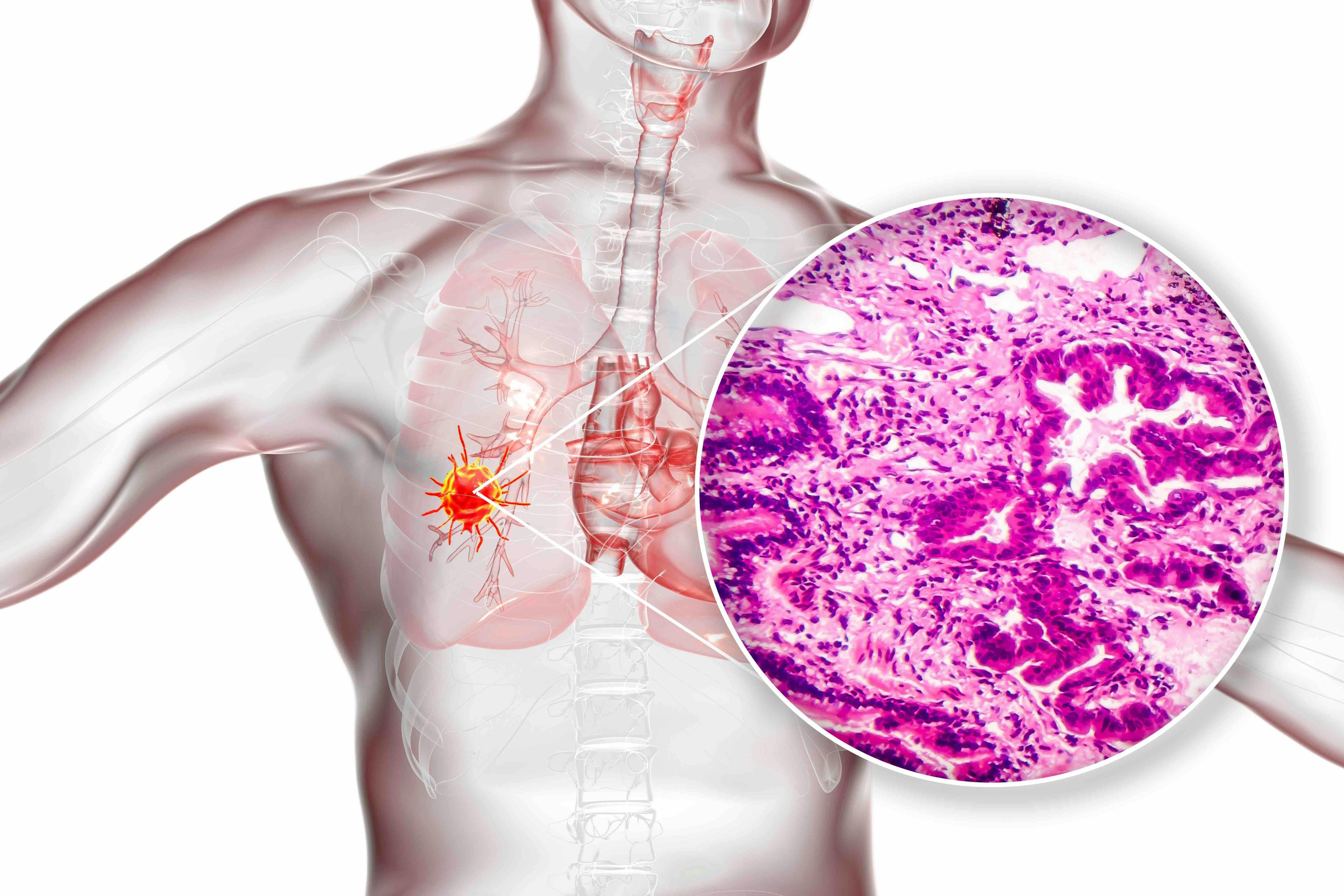 Lung cancer illustration | Image credit: Dr_Microbe - stock.adobe.com