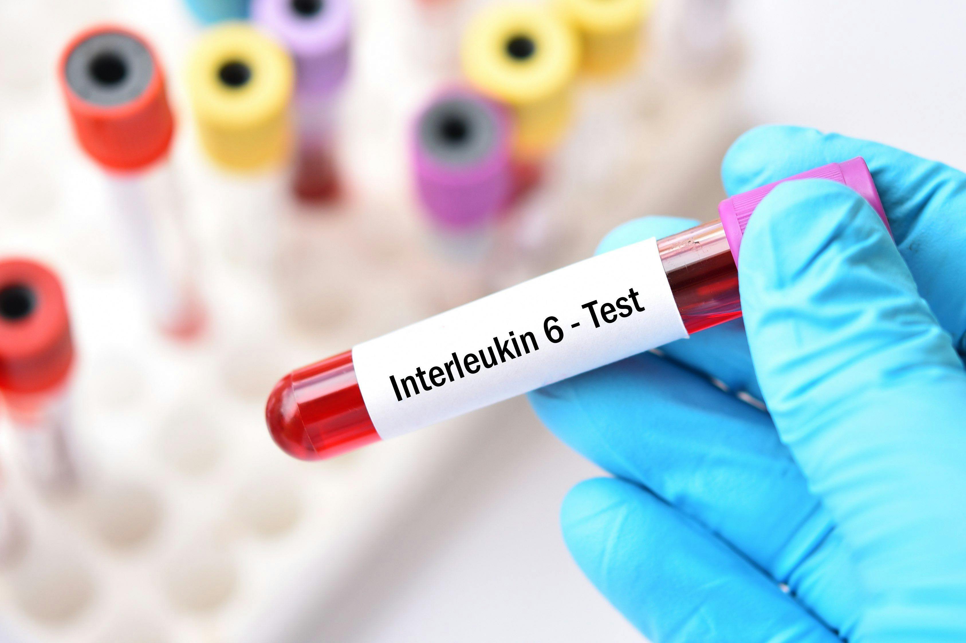 Interleukin 6 blood test | Image credit: jarun011 - stock.adobe.com