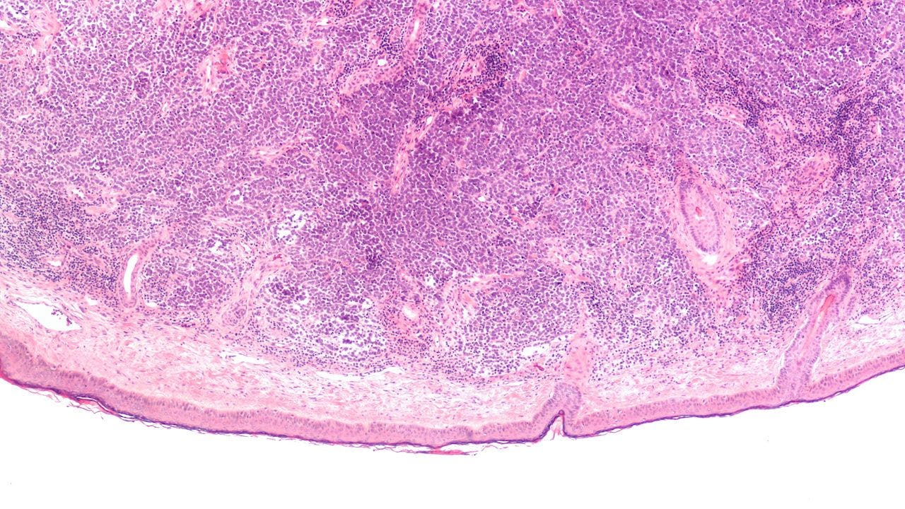 Microscopic image (photomicrograph) of a Merkel cell carcinoma:  ©  David A Litman - stock.adobe.com