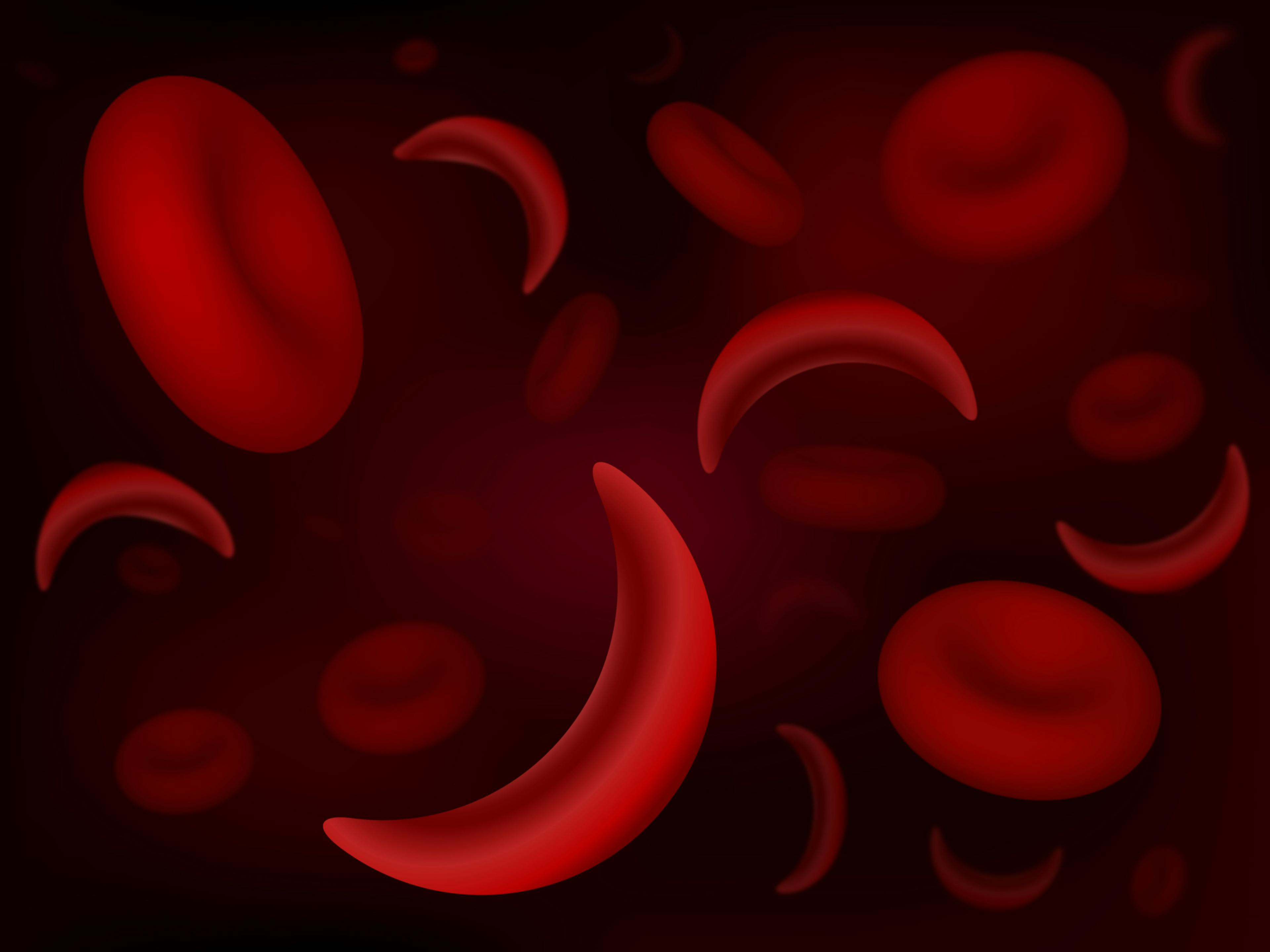 Sickle-cell and normal red blood cells | Image credit: extender_01 - stock.adobe.com