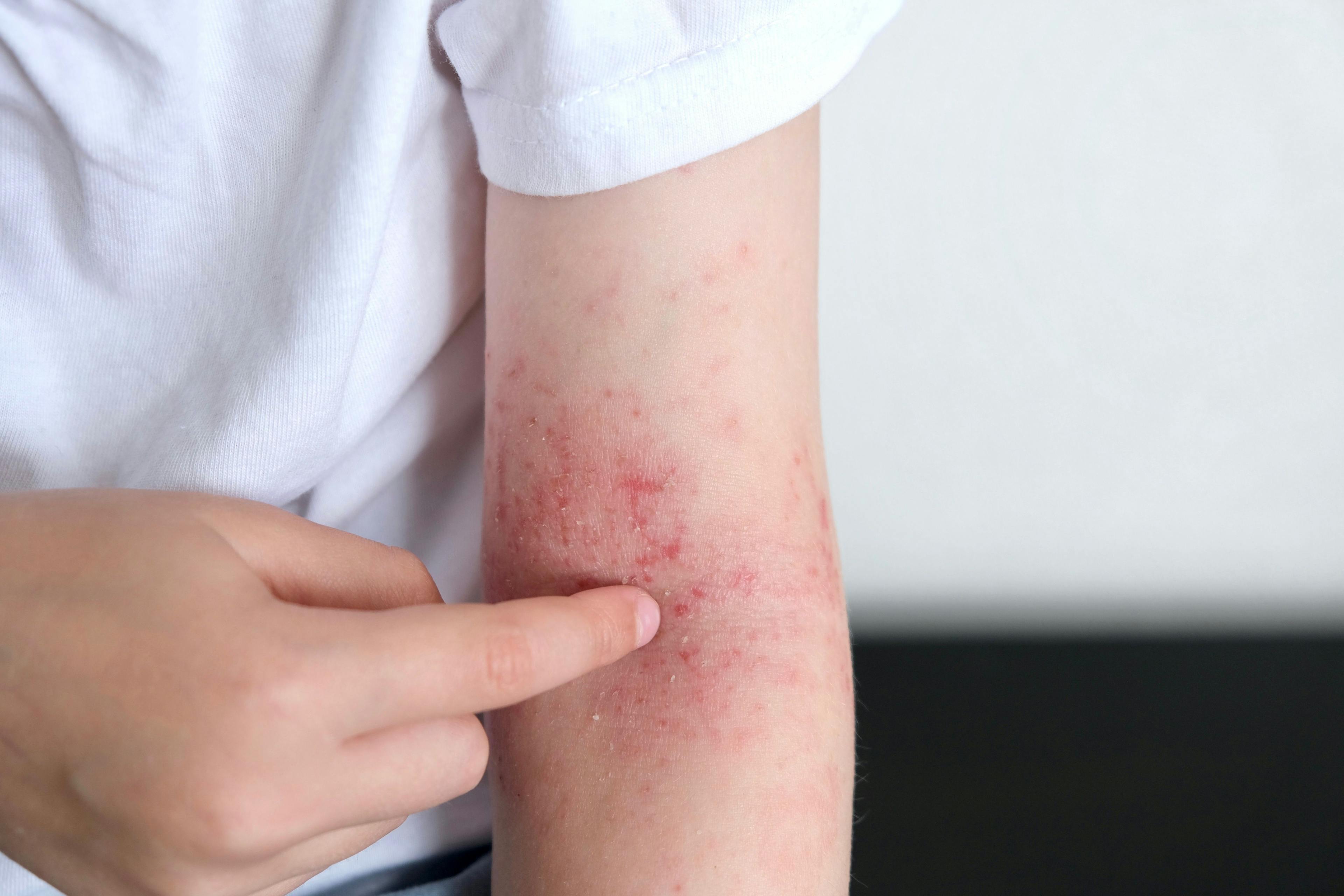 child with atopic dermatitis