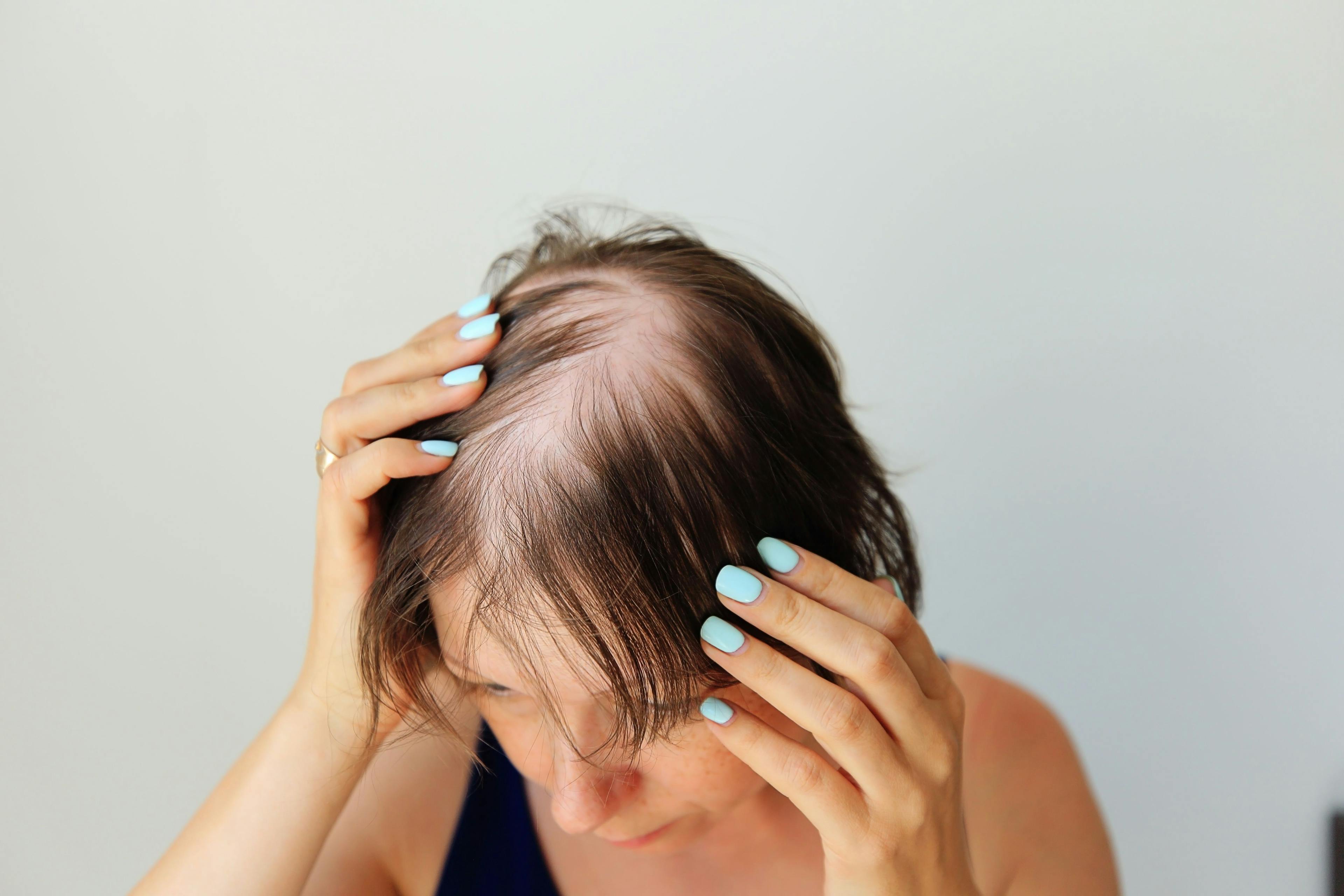 Hair loss | Image Credit: Nadya Kolobova - stock.adobe.com