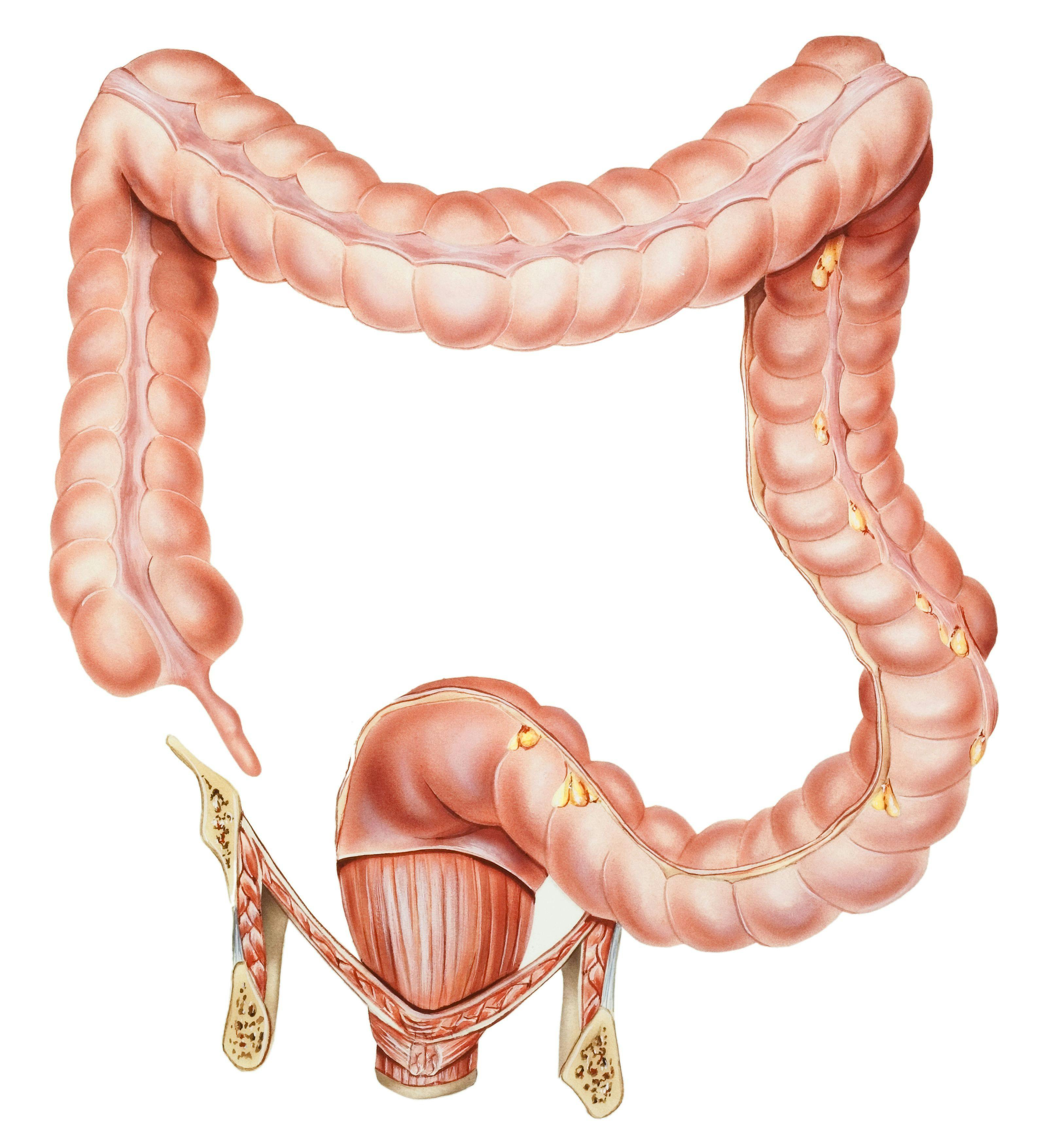 Guidance Describes Management of Malignant Colorectal Polyps