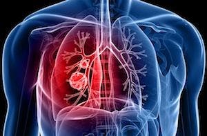 Checkpoint Inhibitors Associated With Prolonged Survival in NSCLC