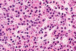Study Examines Cost-Effectiveness in Multiple Myeloma Treatments