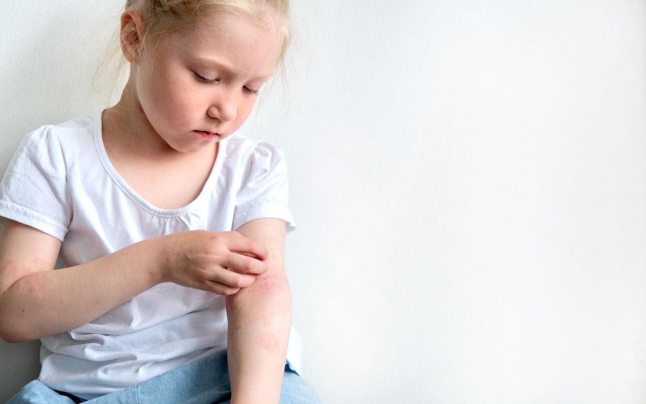 The child scratches atopic skin. Dermatitis, diathesis, allergy on the child's body: © Марина Терехова - stock.adobe.com