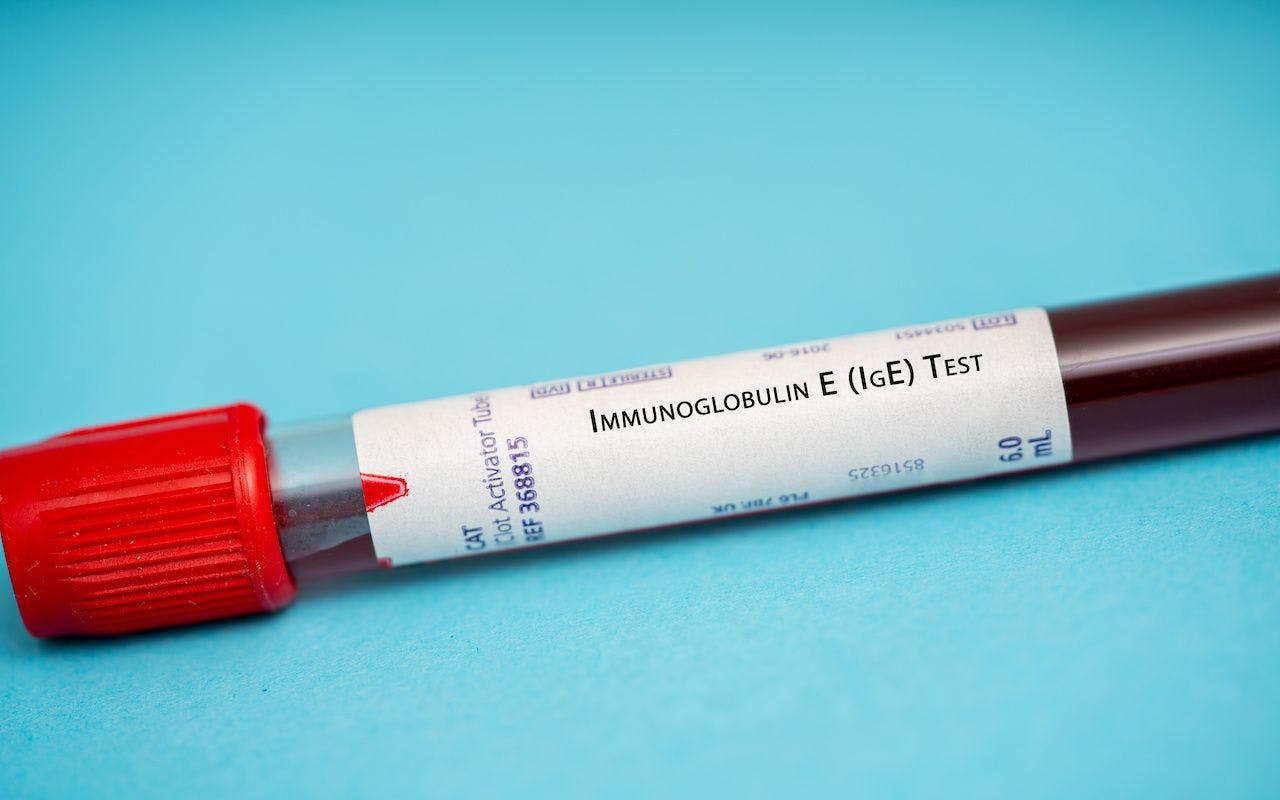 Immunoglobulin E (IgE) Test: © luchschenF - stock.adobe.com