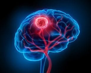 Study Identifies Association Between Migraine History, Brain Tumors