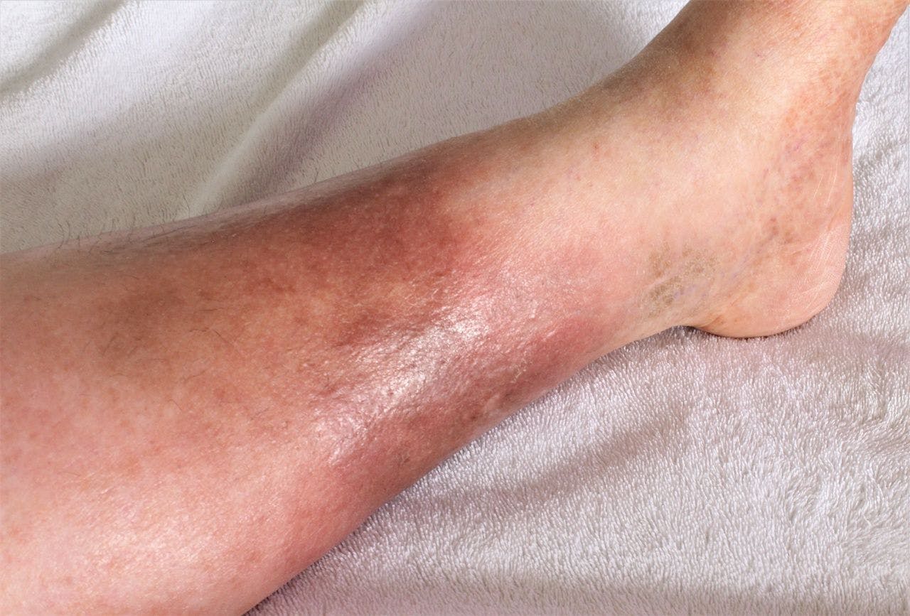 A woman's leg is shown, she is suffering from Chronic Venous Insufficiency with mild cellulitis in her legs. In bed as she rest to relieve heaviness, swelling, pain redness in the leg. Top shot See Less: © Blue - stock.adobe.com