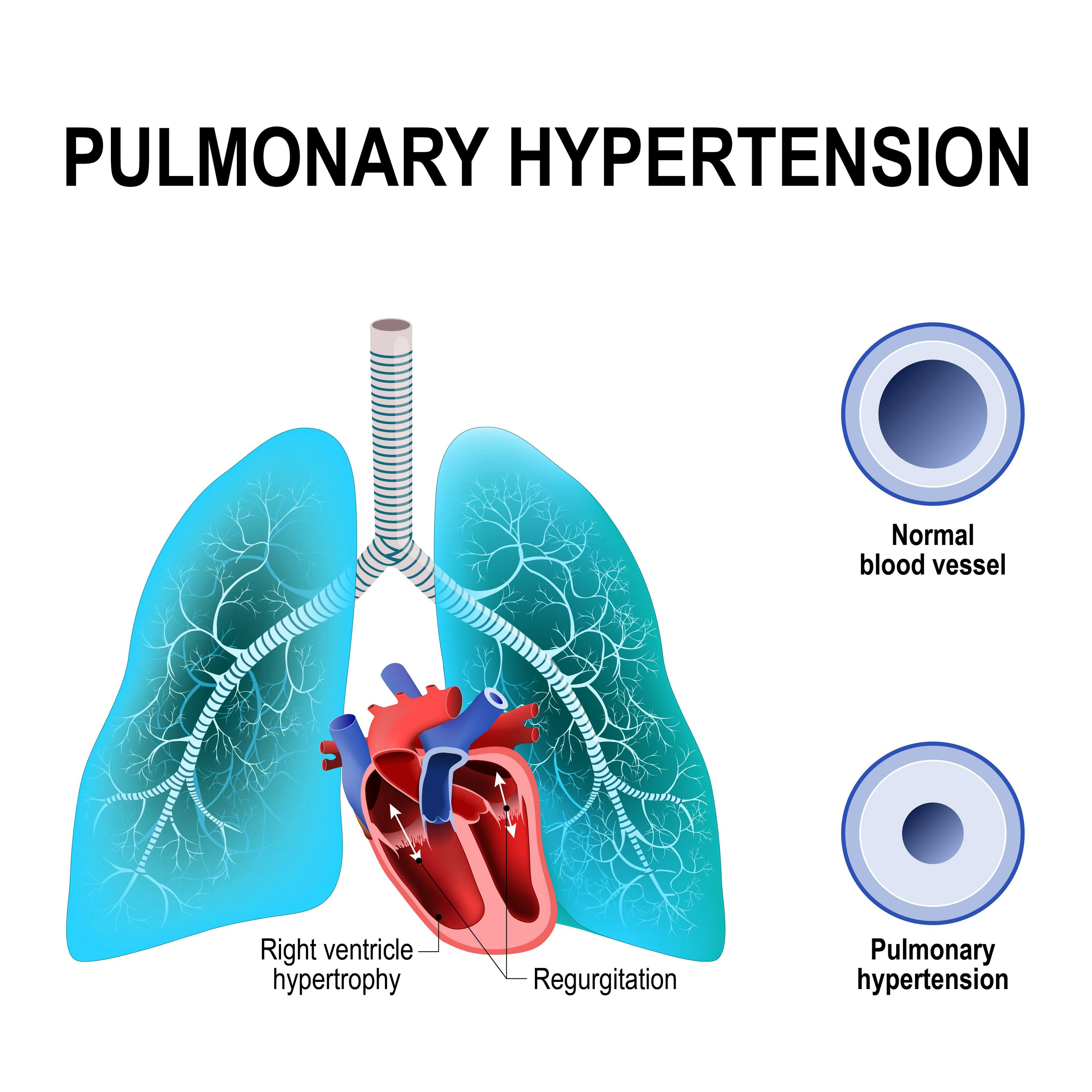 Pulmonary hypertension | Image credit: designua - stock.adobe.com