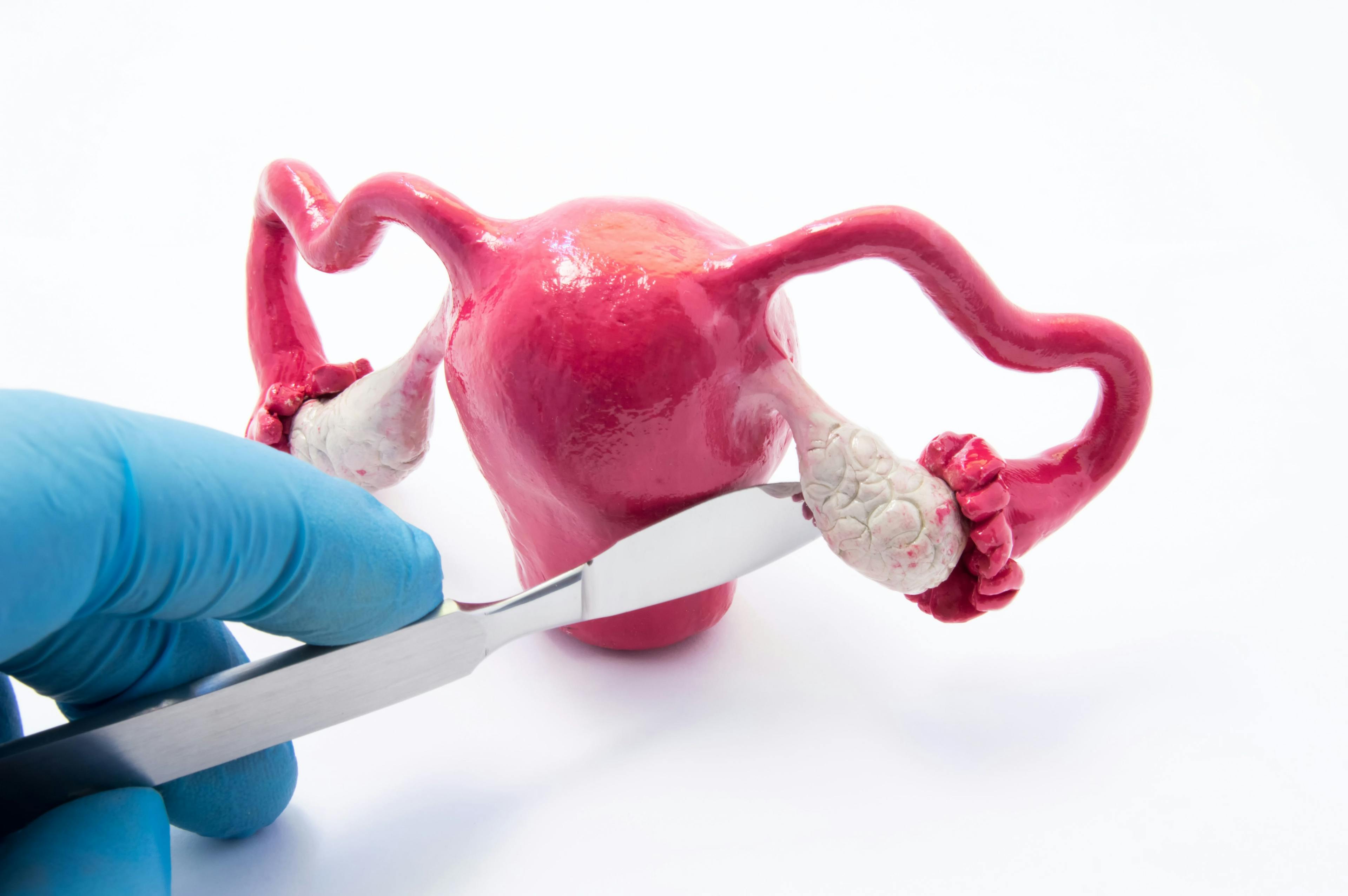 Surgeon holding scalpel near ovary | Image Credit: shidlovski – stock.adobe.com