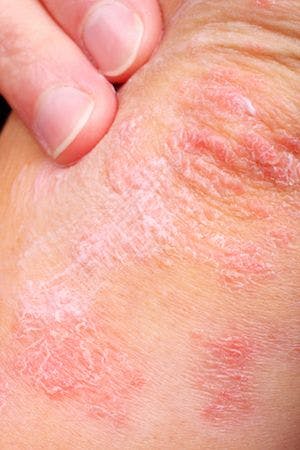 Review Finds Several Biologics Effective in Treating Form of Palmoplantar Psoriasis