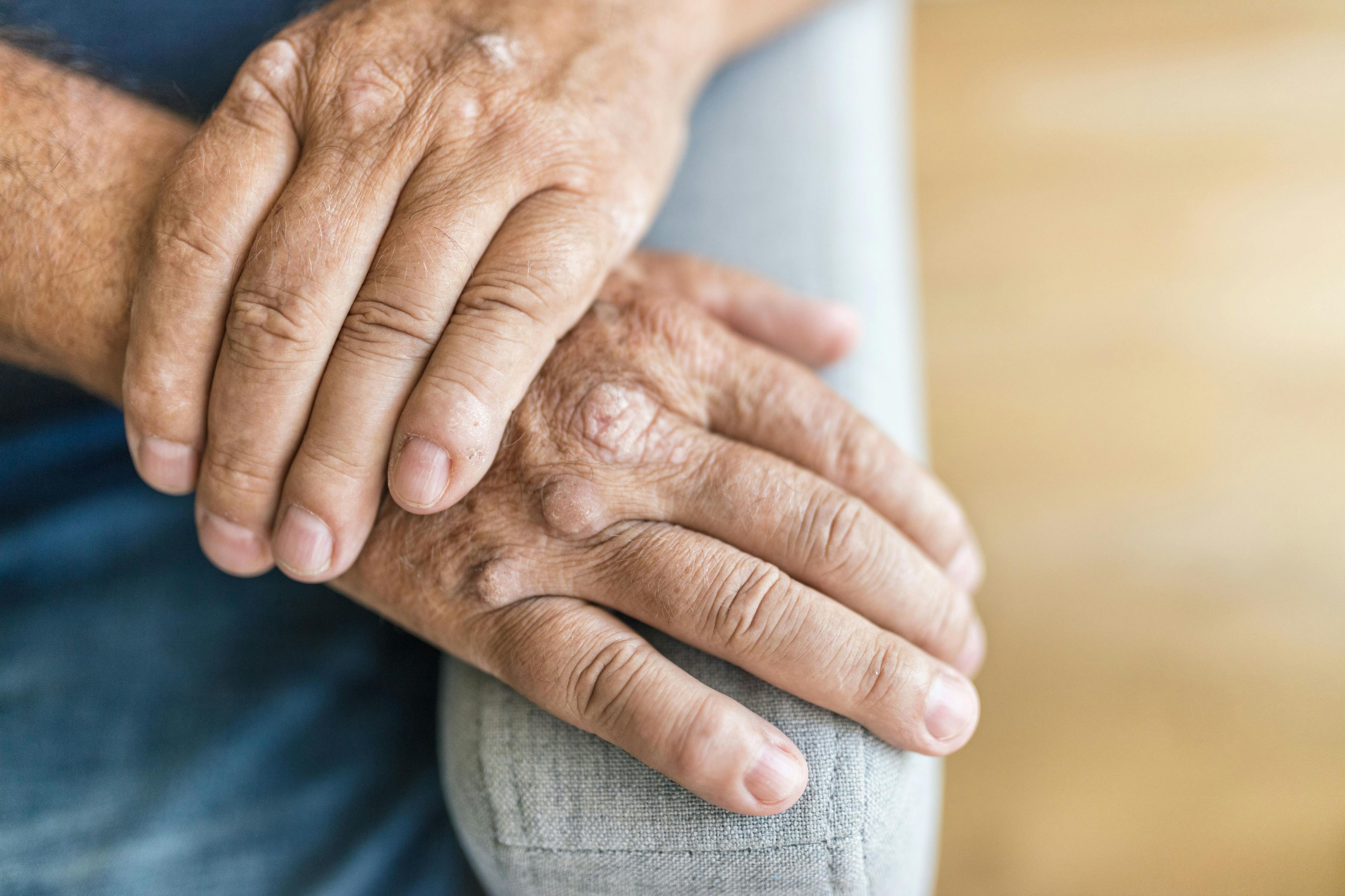 Elderly man suffering from psoriasis on hands | and.one - stock.adobe.com
